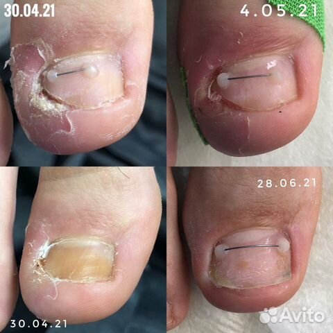 Медицинский педикюр подолог