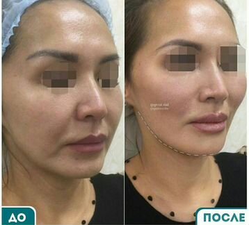 Скидка 50 на нитевой лифтинг. К тренеру моделью